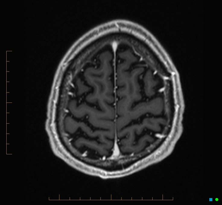 Cerebellar gangliocytoma (Radiopaedia 65377-74422 Axial T1 C+ 124).jpg