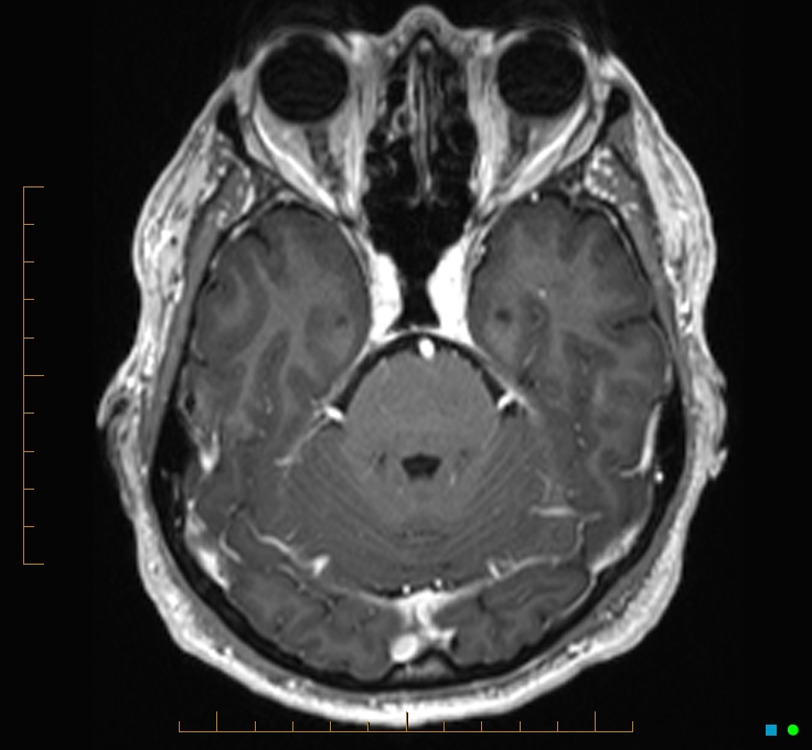 Cerebellar gangliocytoma (Radiopaedia 65377-74422 Axial T1 C+ 36).jpg