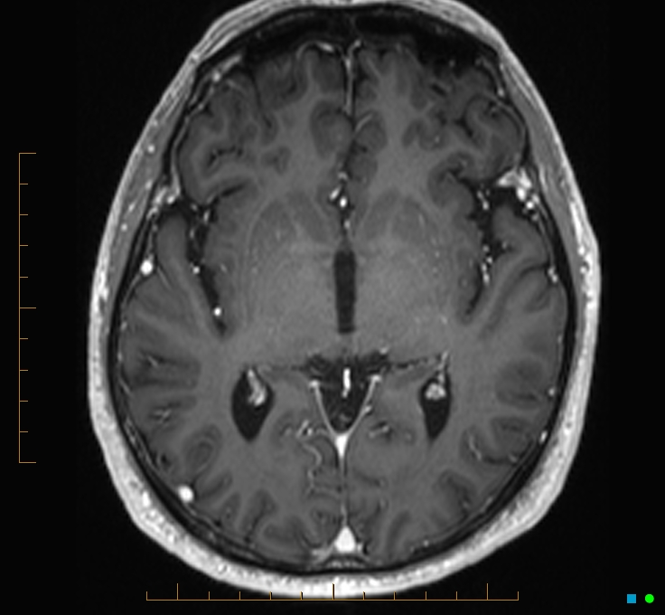 Cerebellar gangliocytoma (Radiopaedia 65377-74422 Axial T1 C+ 62).jpg