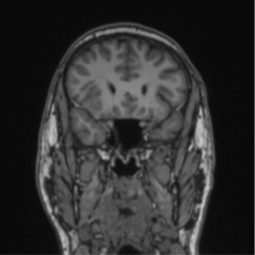 File:Cerebellar hemangioblastomas and pituitary adenoma (Radiopaedia 85490-101176 Coronal T1 64).png