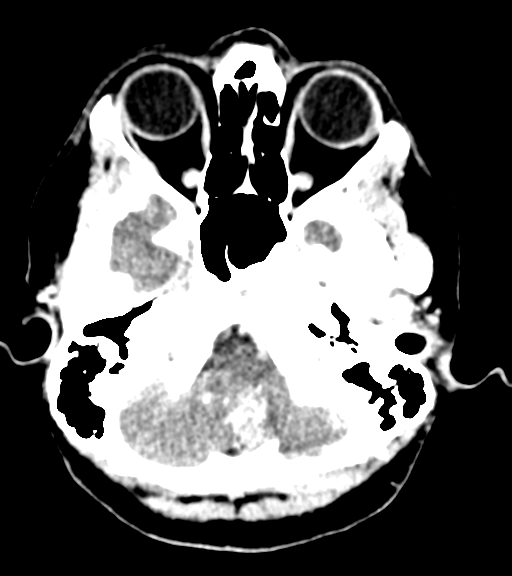 Cerebellar metastases - colorectal adenocarcinoma (Radiopaedia 40947-43652 Axial C+ 7).png