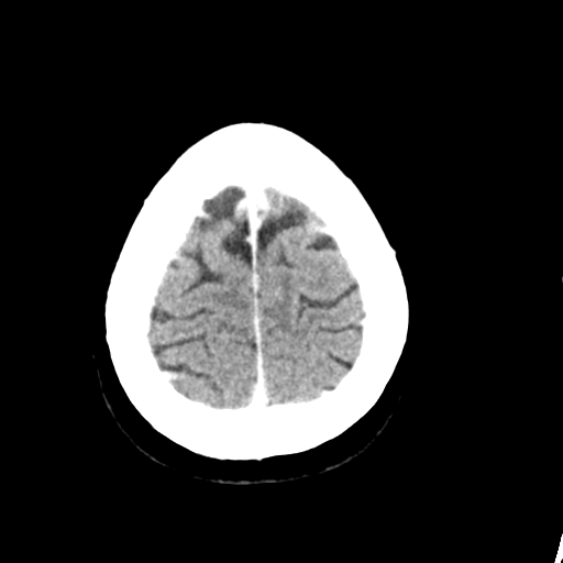 Cerebellar metastasis (Radiopaedia 54578-60812 Axial C+ 44).png