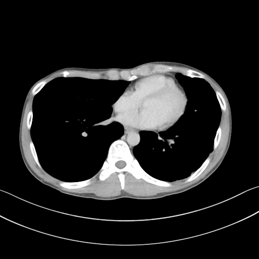 Cerebellar metastasis - adenocarcinoma lung (Radiopaedia 63184-71717 Axial C+ delayed 44).png