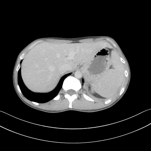 Cerebellar metastasis - adenocarcinoma lung (Radiopaedia 63184-71717 Axial C+ delayed 64).png