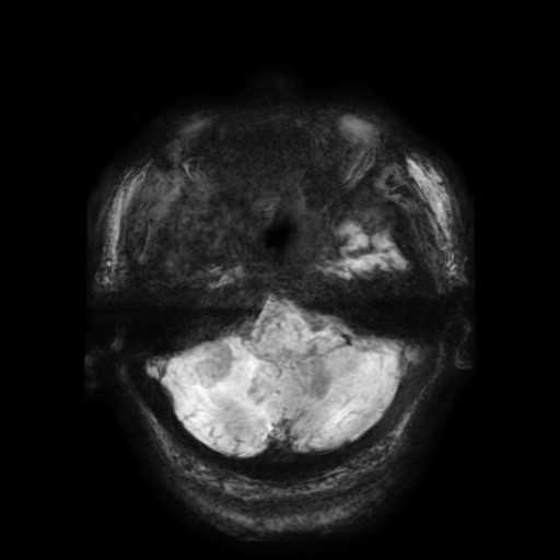Cerebellar metastasis of pulmonary adenocarcinoma, cavernous venous malformation, and developmental venous anomaly (Radiopaedia 85827-101661 Axial SWI 55).jpg