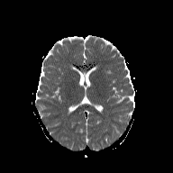 File:Cerebellar stroke (Radiopaedia 32202-33150 Axial ADC 14).png