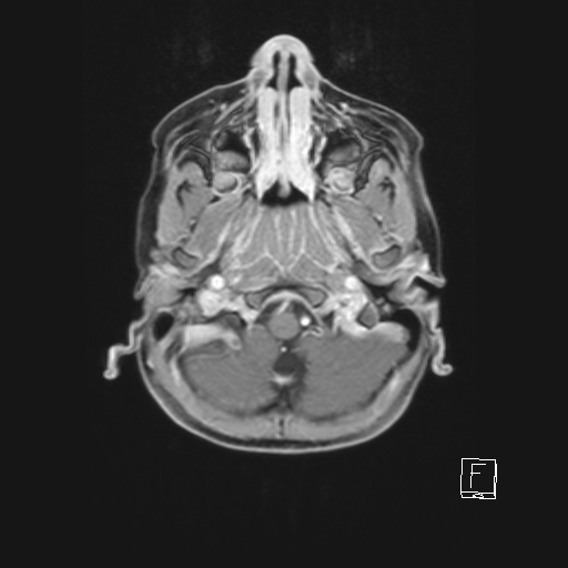 Cerebellar stroke (Radiopaedia 32202-33150 Axial T1 C+ 18).png