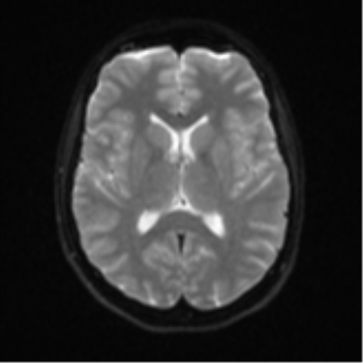 Cerebellar tuberculomas (Radiopaedia 46939-51472 Axial DWI 16).png