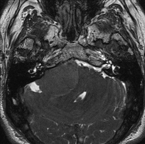 Cerebellopontine angle meningioma (Radiopaedia 24459-24764 I 21).jpg