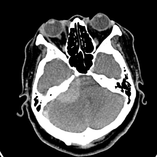 Cerebellopontine angle meningioma (Radiopaedia 35181-36714 A 23).jpg