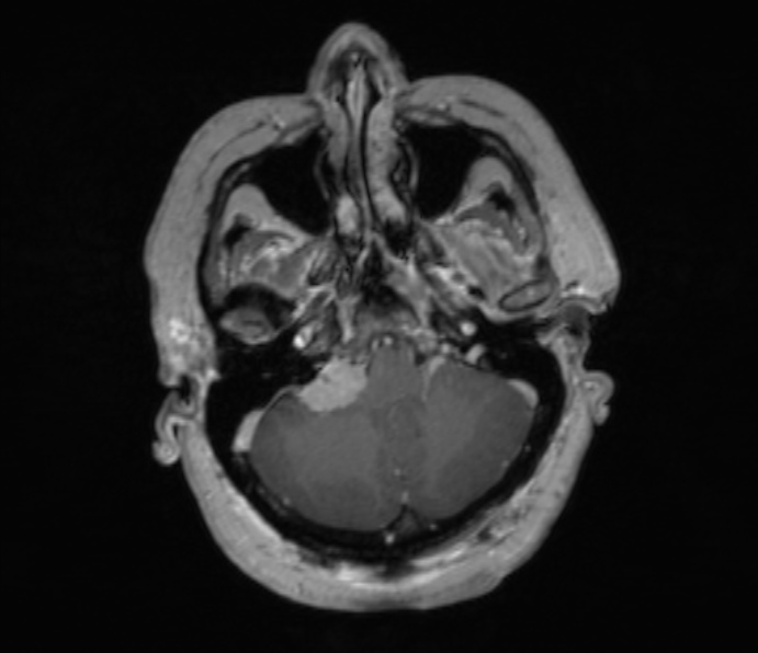 Cerebellopontine angle meningioma (Radiopaedia 35181-36715 Axial T1 C+ 44).jpg