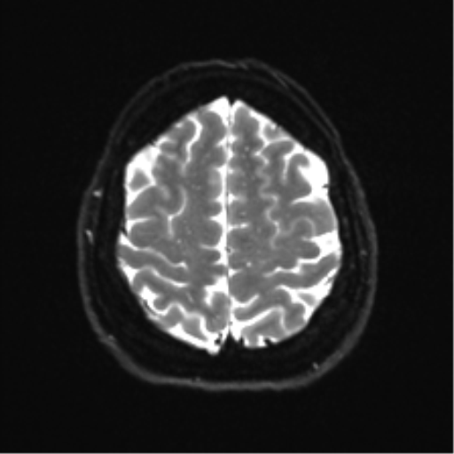 Cerebellopontine angle meningioma (Radiopaedia 48434-53348 Axial DWI 32).png