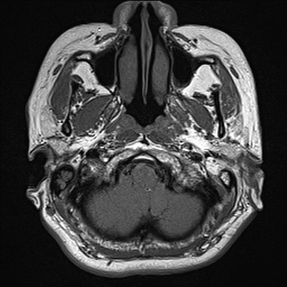 File:Cerebellopontine angle meningioma (Radiopaedia 53561-59591 Axial T1 1).jpg