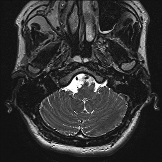 Cerebellopontine angle meningioma (Radiopaedia 72983-83680 Axial FIESTA 4).jpg