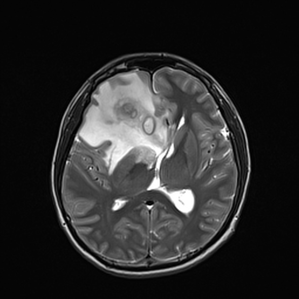 Cerebral abscess (Radiopaedia 24212-24478 Axial T2 34).jpg