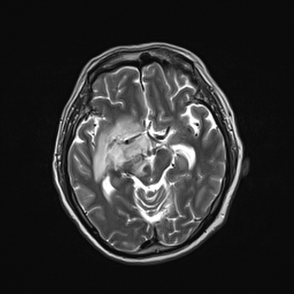Cerebral abscess (Radiopaedia 26111-26247 Axial T2 28).jpg