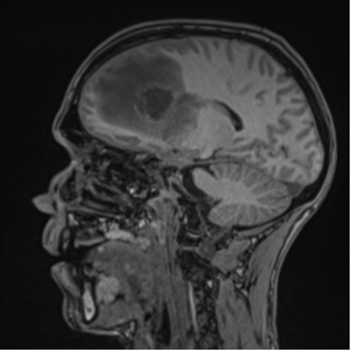 Cerebral abscess (Radiopaedia 60342-68009 Sagittal T1 34).png