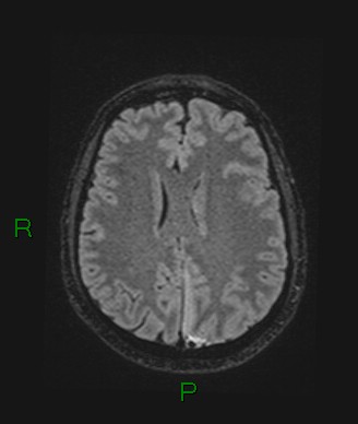 Cerebral abscess and subdural empyema (Radiopaedia 84436-99779 Axial FLAIR 33).jpg