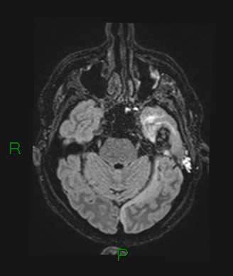 Cerebral abscess and subdural empyema (Radiopaedia 84436-99779 Axial FLAIR 60).jpg