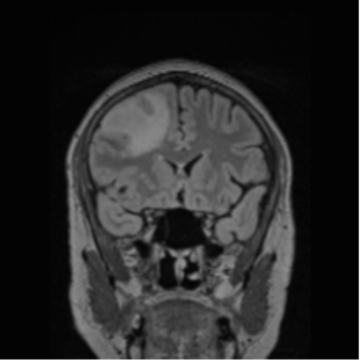Cerebral abscess from pulmonary arteriovenous malformation (Radiopaedia 86275-102291 Coronal FLAIR 61).png