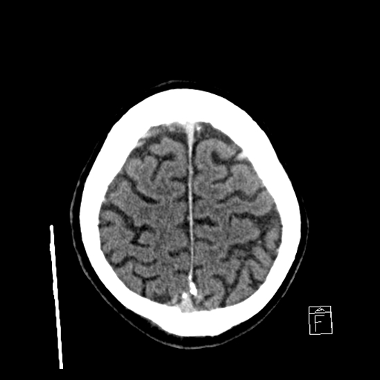 File:Cerebral abscess with ventriculitis (Radiopaedia 78965-91877 A 40).jpg