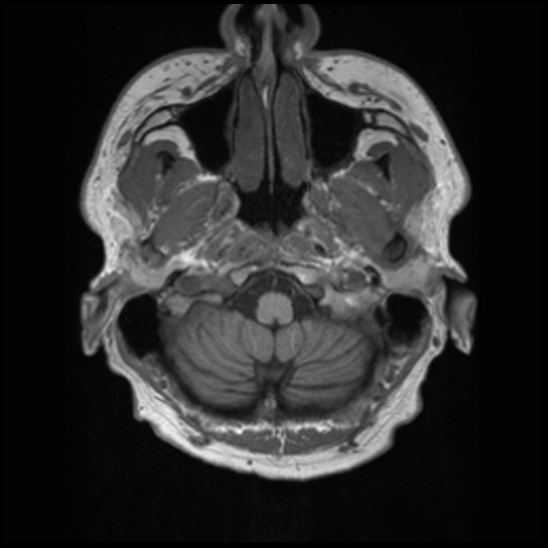 File:Cerebral abscess with ventriculitis (Radiopaedia 78965-91878 Axial T1 5).jpg