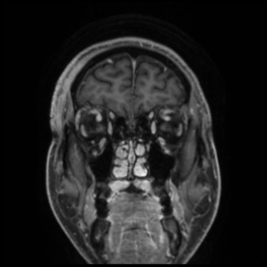 Cerebral abscess with ventriculitis (Radiopaedia 78965-91878 Coronal T1 C+ 14).jpg