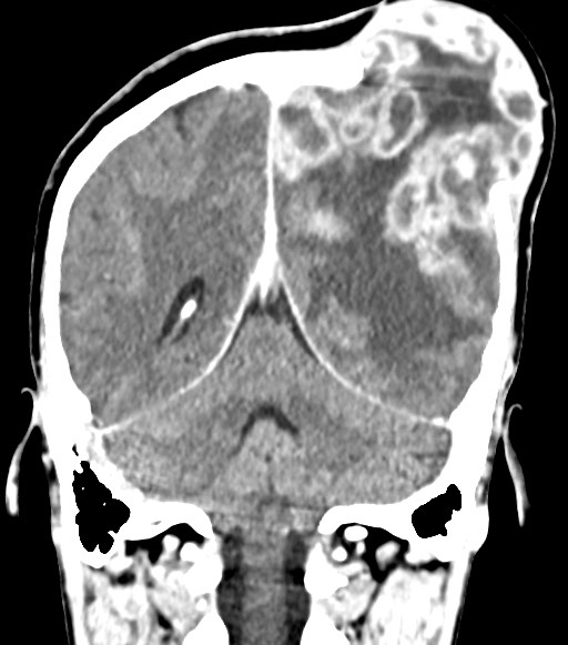 Cerebral abscesses (Radiopaedia 70458-80568 Coronal Contrast 46).jpg