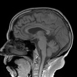 File:Cerebral amyloid angiopathy-related inflammation (Radiopaedia 74836-85849 Sagittal T1 17).jpg