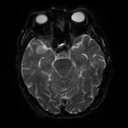Cerebral amyloid angiopathy (Radiopaedia 28698-28978 Axial DWI 38).jpg