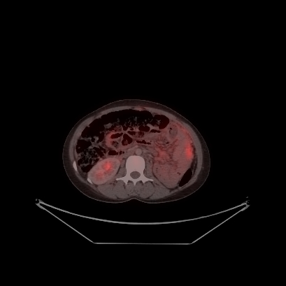 Cerebral and abdominal tuberculosis (Radiopaedia 90499-107853 C 166).jpg