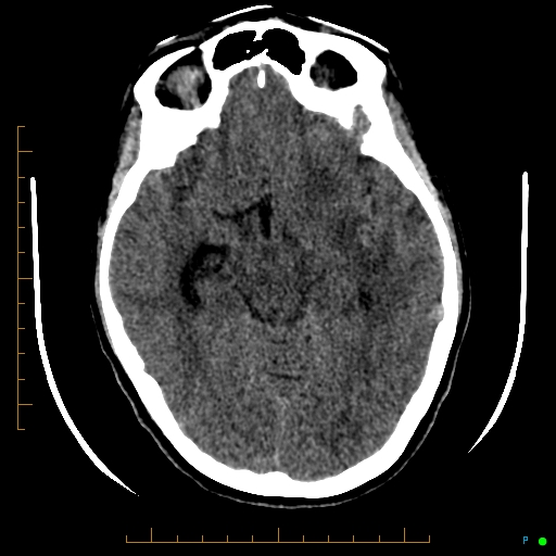 Cerebral arteriovenous malformation (AVM) (Radiopaedia 78162-90706 Axial non-contrast 27).jpg