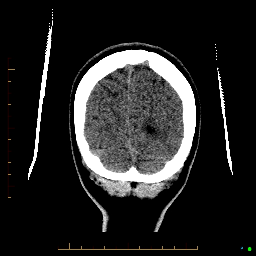 Cerebral arteriovenous malformation (AVM) (Radiopaedia 78162-90706 Coronal non-contrast 87).jpg