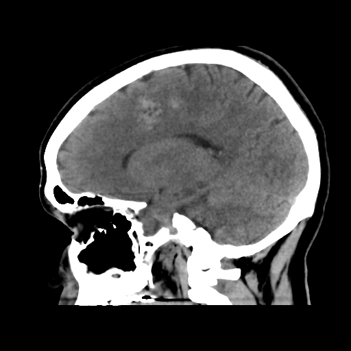 File:Cerebral arteriovenous malformation (Radiopaedia 39259-41505 B 16).png