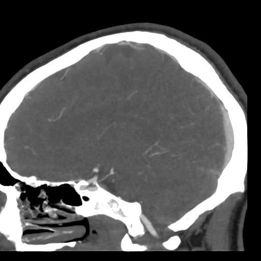 Cerebral arteriovenous malformation (Radiopaedia 39259-41505 Sagittal 35).png