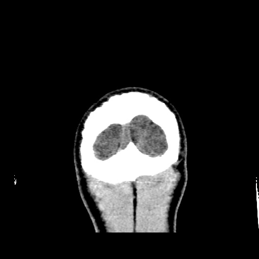 Cerebral arteriovenous malformation (Radiopaedia 61964-70028 Coronal non-contrast 59).jpg