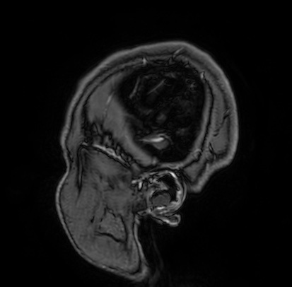 Cerebral arteriovenous malformation (Radiopaedia 74411-85654 Sagittal T1 C+ 3).jpg