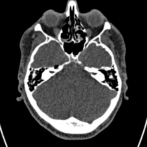 Cerebral arteriovenous malformation (Radiopaedia 78188-90746 Axial non-contrast 48).jpg