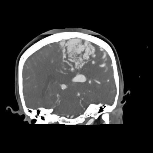File:Cerebral arteriovenous malformation (Radiopaedia 79677-92888 B 24).jpg