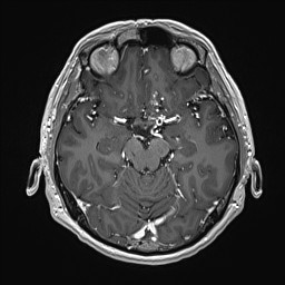 Cerebral arteriovenous malformation (Radiopaedia 84015-99245 Axial T1 C+ 65).jpg