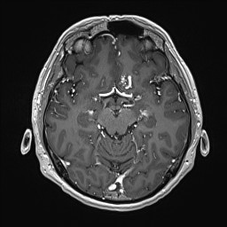 Cerebral arteriovenous malformation (Radiopaedia 84015-99245 Axial T1 C+ 67).jpg