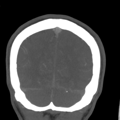 Cerebral arteriovenous malformation (Spetzler-Martin grade 2) (Radiopaedia 41262-44076 F 54).png