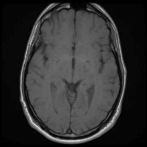 File:Cerebral arteriovenous malformation (Spetzler-Martin grade 2) (Radiopaedia 41262-44092 Axial T1 9).png