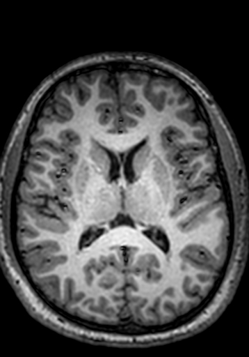 Cerebral arteriovenous malformation at posterior body of corpus callosum (Radiopaedia 74111-84925 Axial T1 129).jpg