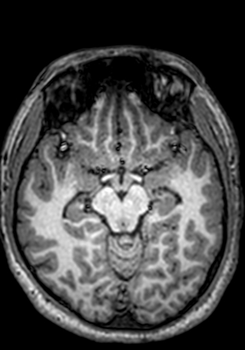 File:Cerebral arteriovenous malformation at posterior body of corpus callosum (Radiopaedia 74111-84925 Axial T1 182).jpg
