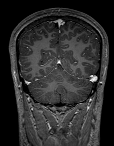 Cerebral arteriovenous malformation at posterior body of corpus callosum (Radiopaedia 74111-84925 K 285).jpg