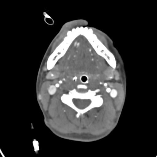 Cerebral arteriovenous malformation with hemorrhage (Radiopaedia 28773-29073 A 68).jpg