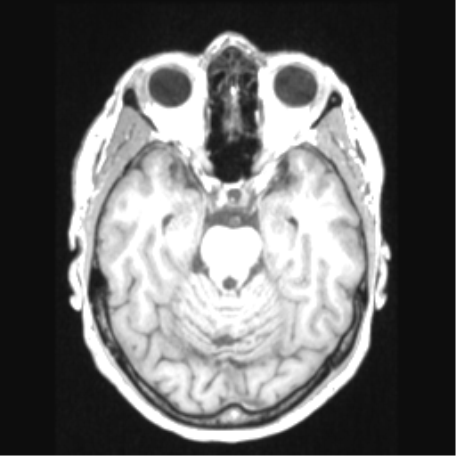 File:Cerebral arteriovenous malformation with hemorrhage (Radiopaedia 34422-35737 Axial T1 28).png