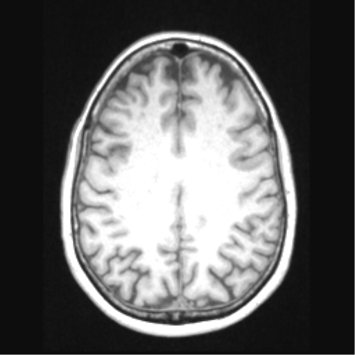 File:Cerebral arteriovenous malformation with hemorrhage (Radiopaedia 34422-35737 Axial T1 52).png