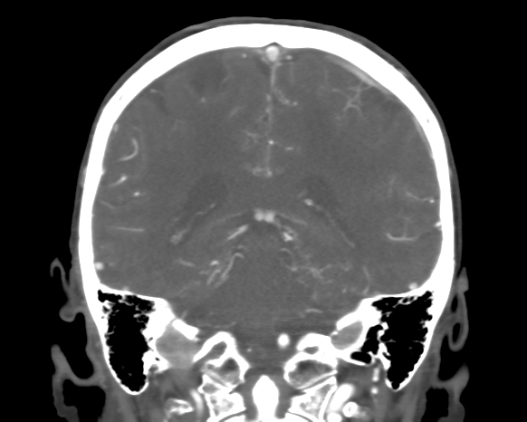 Cerebral arteriovenous malformation with lobar hemorrhage (Radiopaedia 44725-48511 A 38).png